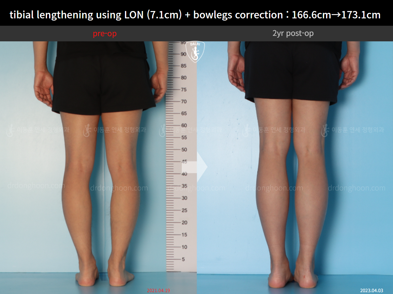 Before and after cll lon, case 14678740, image 8, Dr. Donghoon institute (DALRI)