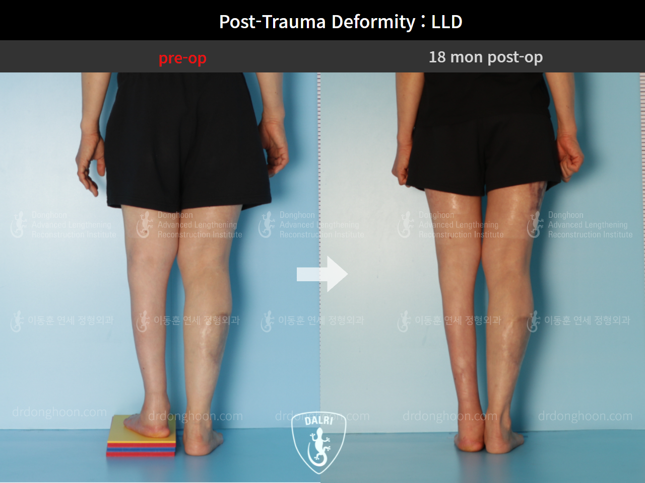 Before and after adult lld, case 9125304, image 6, Dr. Donghoon institute (DALRI)