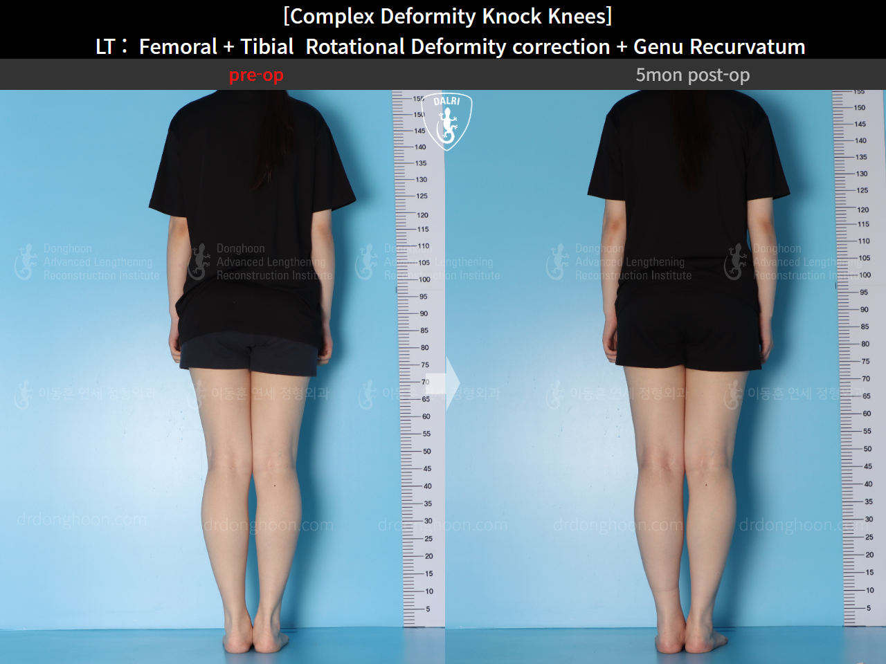 Before and after genu recurvatum, case 16212778, image 5, Dr. Donghoon institute (DALRI)