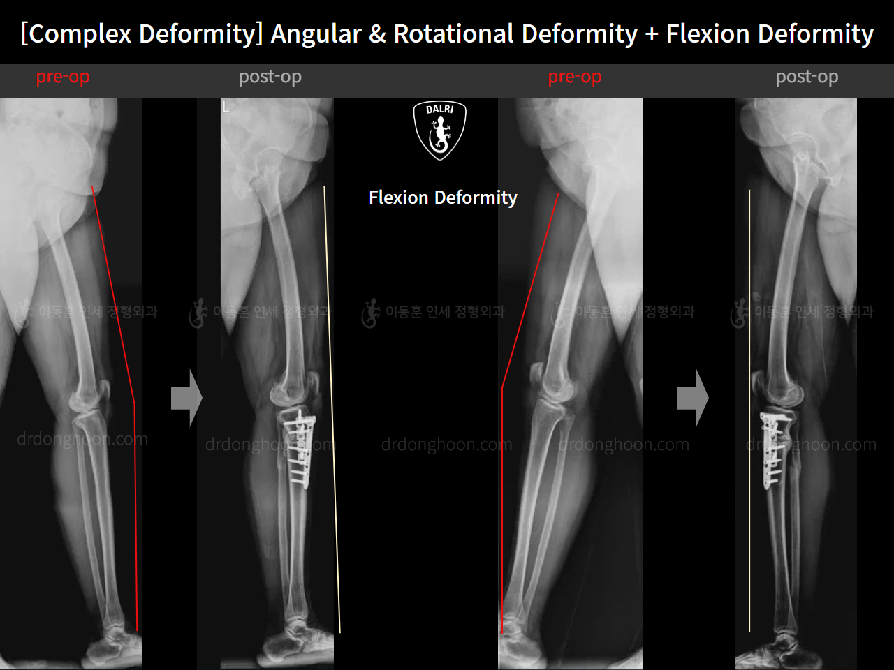 Before and after osteotomy for knee osteoarthritis, case 16781349, image 14, Dr. Donghoon institute (DALRI)