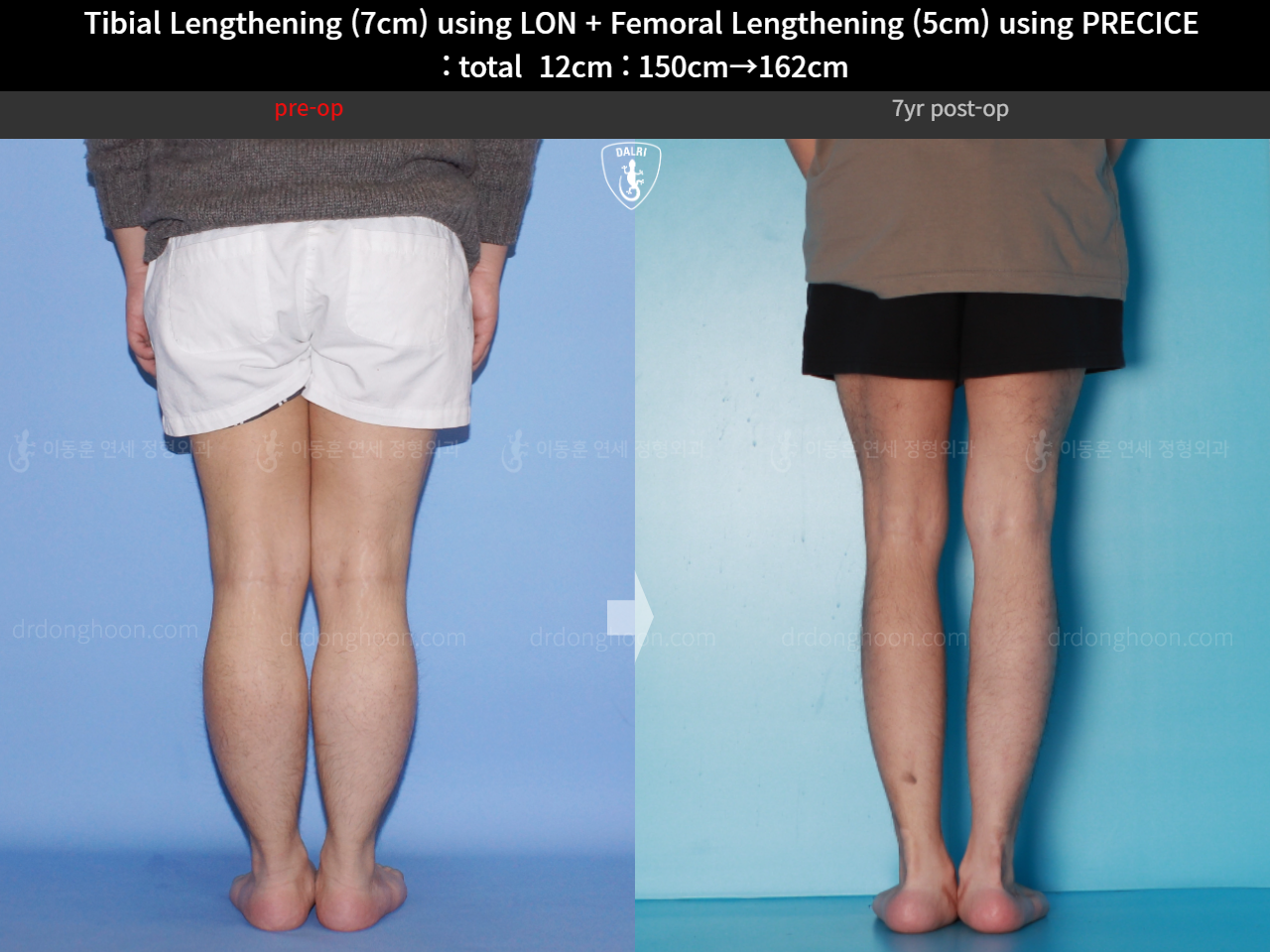 Before and after cll precice, case 16146445, image 10, Dr. Donghoon institute (DALRI)