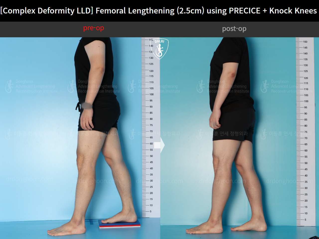 Before and after complex deformity, case 17589126, image 3, Dr. Donghoon institute (DALRI)