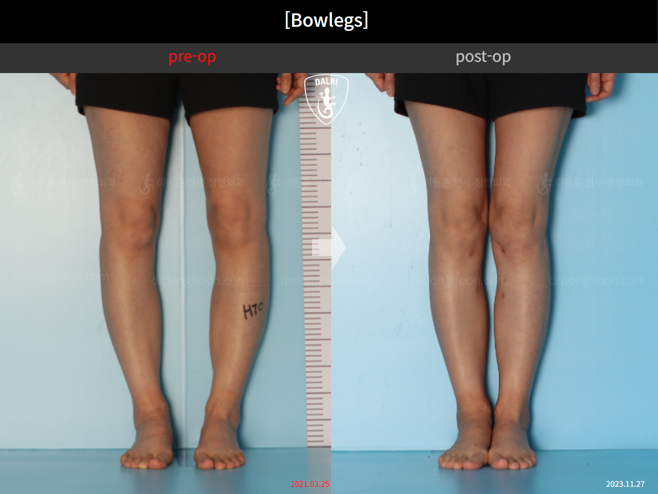 Before and after adult bowlegs, case 17463322, image 5, Dr. Donghoon institute (DALRI)