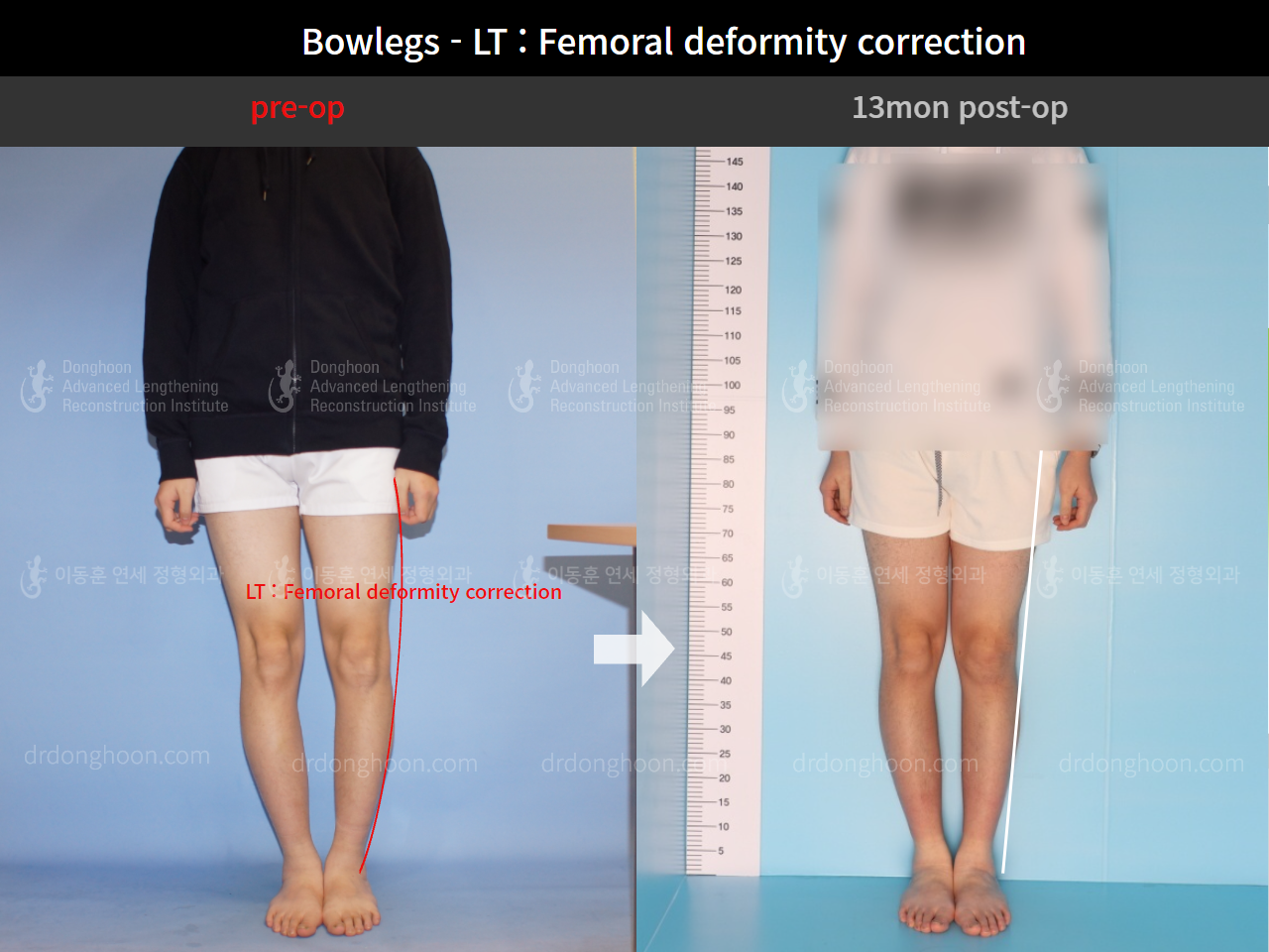 Before and after adult bowlegs, case 8932864, image 1, Dr. Donghoon institute (DALRI)
