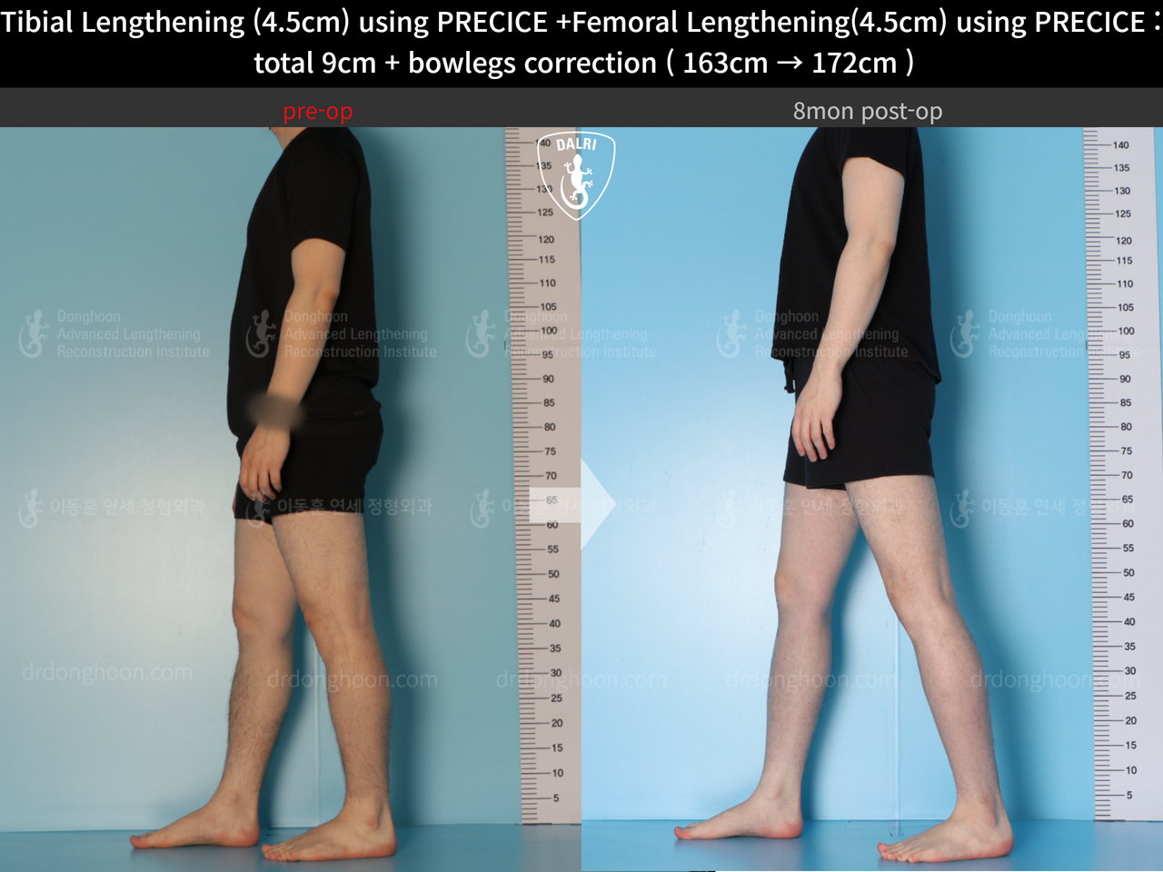 Before and after cll precice, case 13912585, image 6, Dr. Donghoon institute (DALRI)