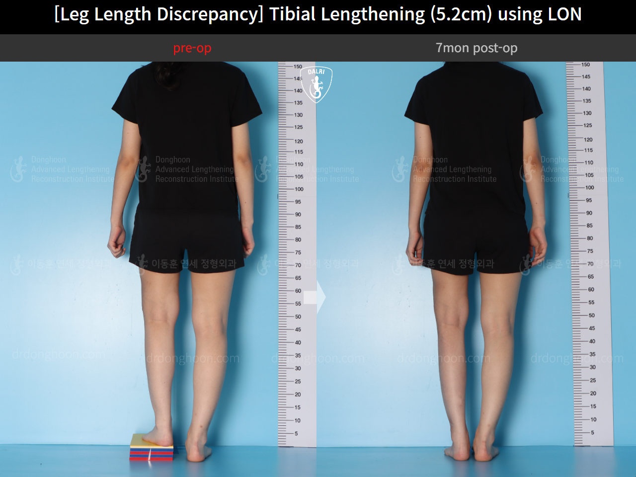 Before and after adult lld, case 16539955, image 2, Dr. Donghoon institute (DALRI)