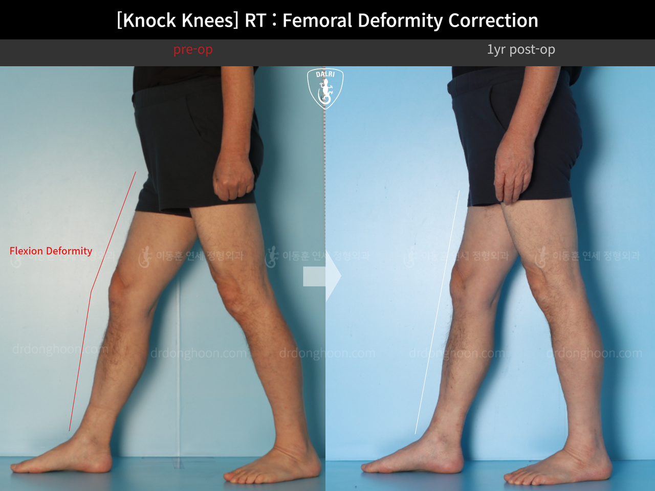 Before and after flexion deformity, case 14236440, image 8, Dr. Donghoon institute (DALRI)