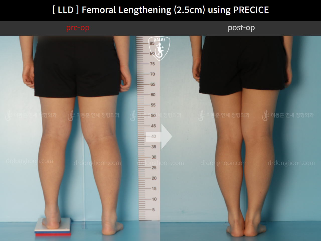 Before and after adult lld, case 11367647, image 6, Dr. Donghoon institute (DALRI)