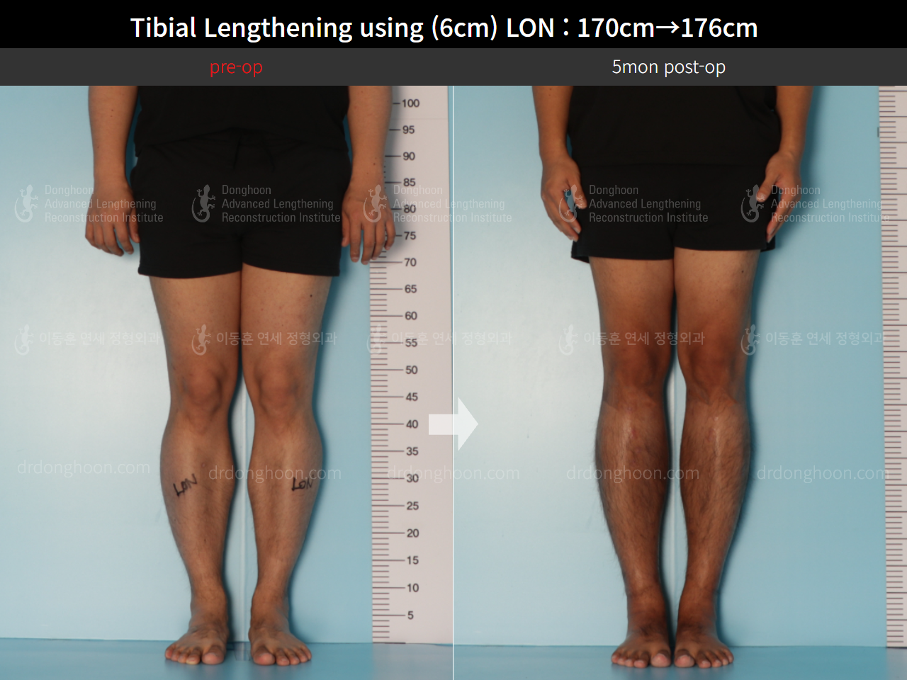 Before and after cll lon, case 8672248, image 5, Dr. Donghoon institute (DALRI)