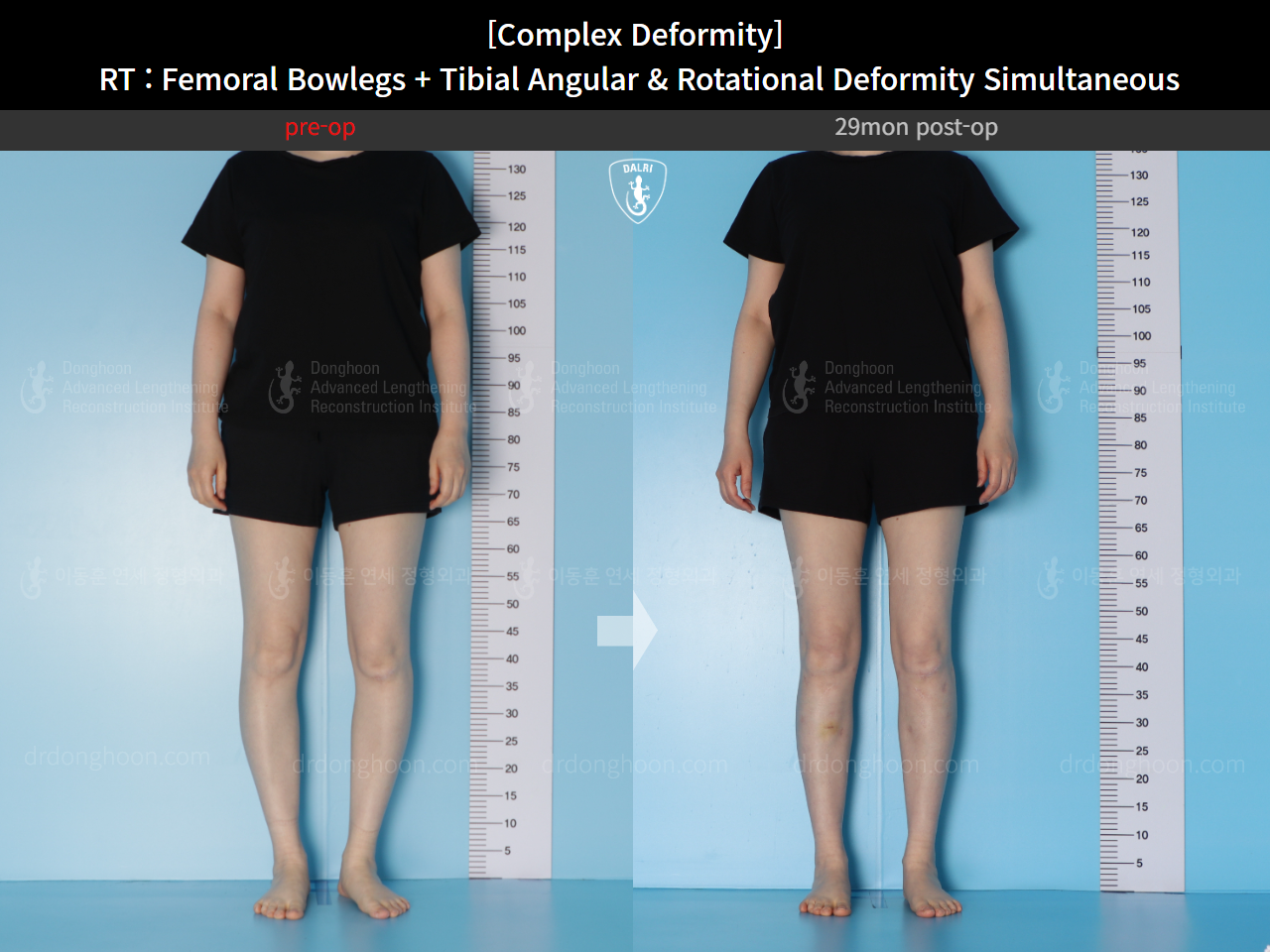 Before and after adult bowlegs, case 14771490, image 3, Dr. Donghoon institute (DALRI)
