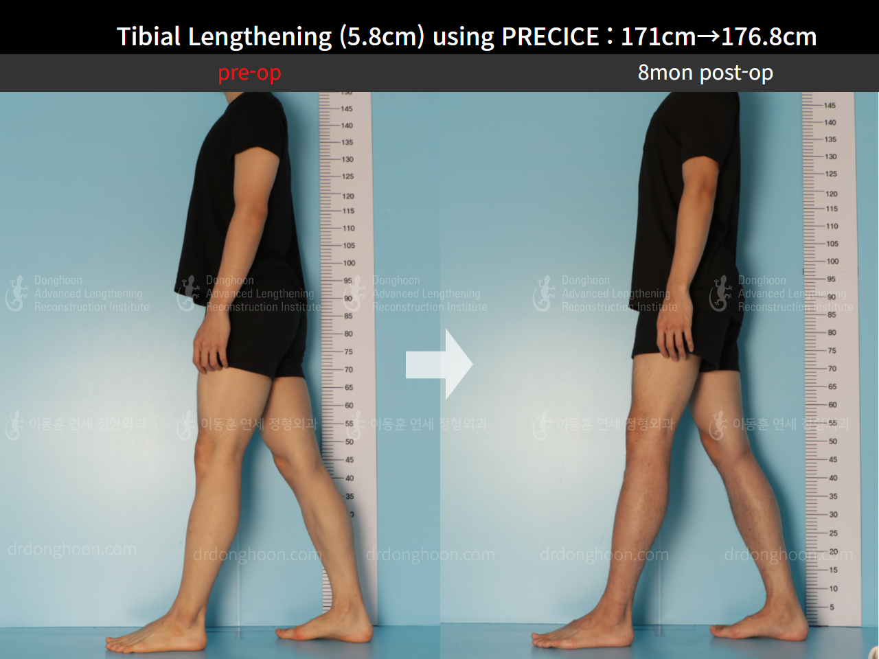 Before and after cll precice, case 8678696, image 3, Dr. Donghoon institute (DALRI)