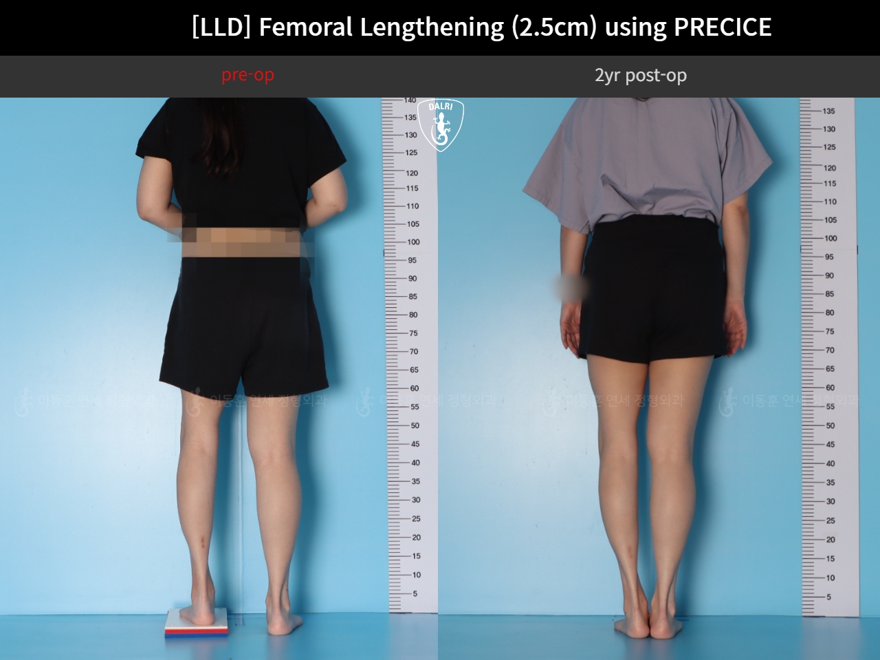 Before and after adult lld, case 89087135, image 2, Dr. Donghoon institute (DALRI)