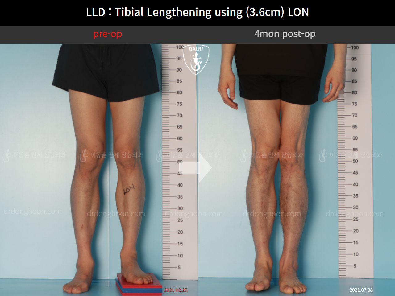Before and after adult lld, case 11093753, image 4, Dr. Donghoon institute (DALRI)