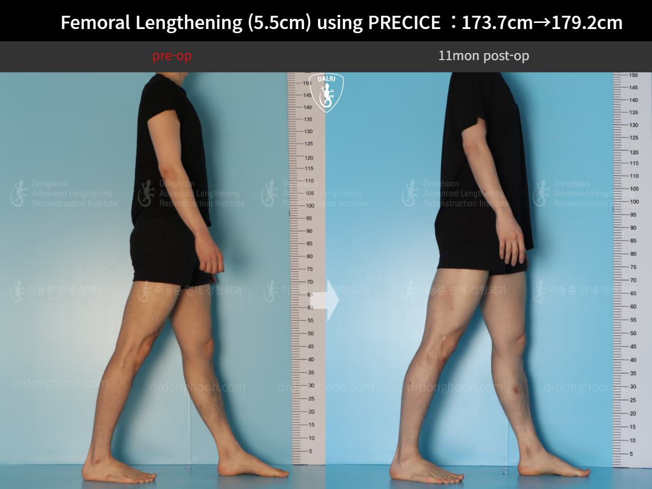 Before and after cll precice, case 18140453, image 4, Dr. Donghoon institute (DALRI)