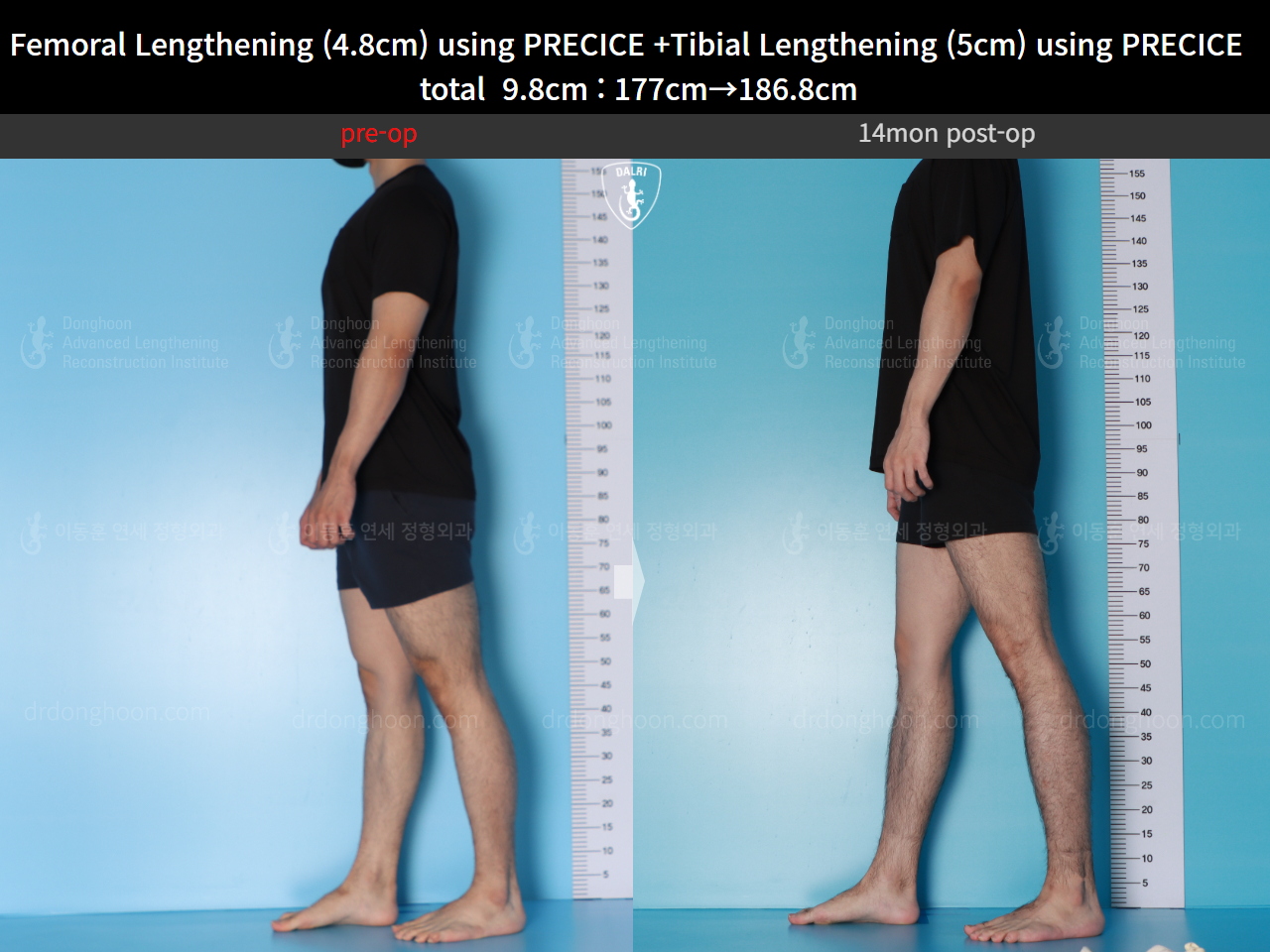 Before and after cll precice, case 16780196, image 6, Dr. Donghoon institute (DALRI)