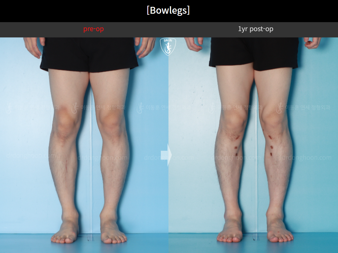Before and after adult bowlegs, case 16724494, image 8, Dr. Donghoon institute (DALRI)