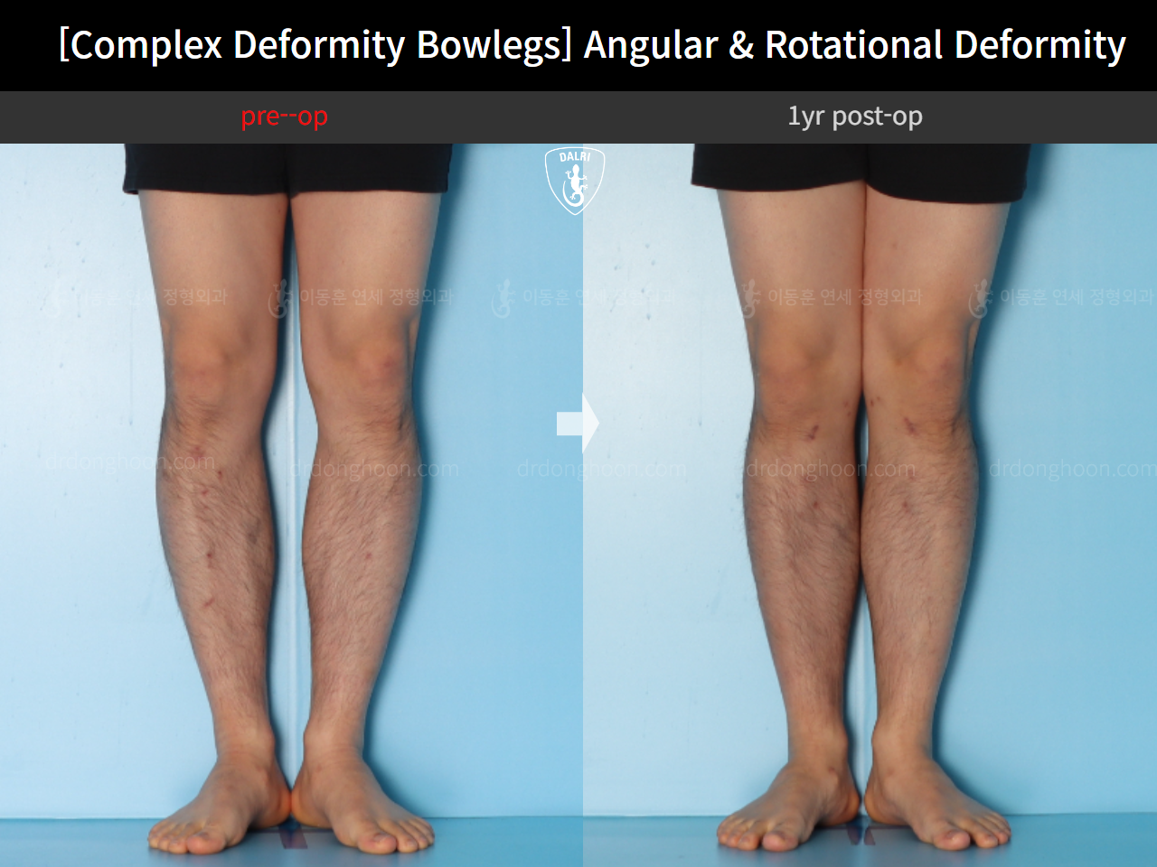Before and after adult bowlegs, case 17229195, image 6, Dr. Donghoon institute (DALRI)