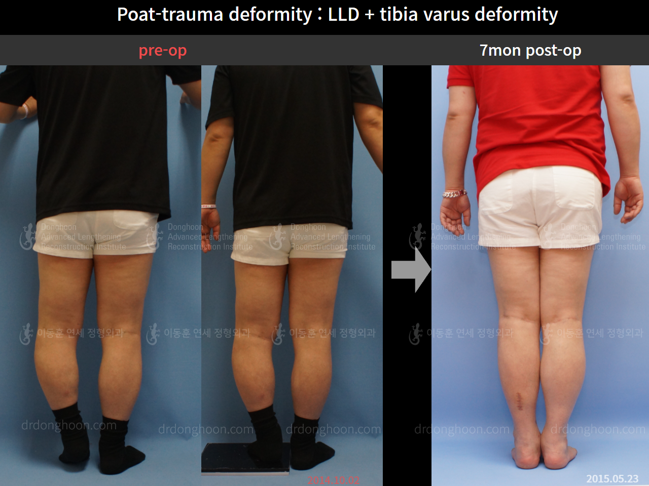 Before and after post-trauma deformity, case 4251798, image 2, Dr. Donghoon institute (DALRI)