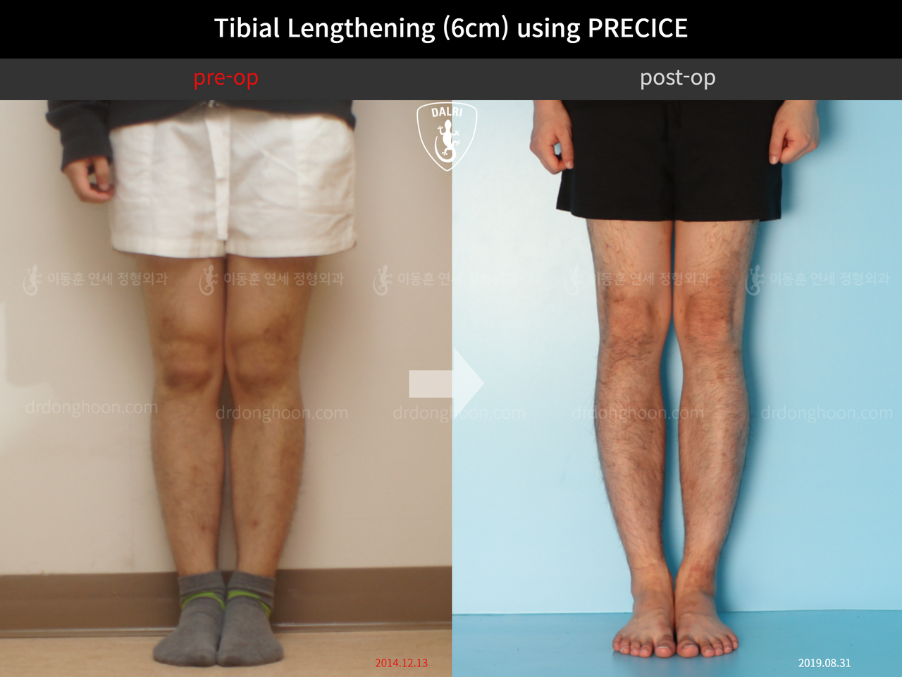 Before and after cll precice, case 11882006, image 3, Dr. Donghoon institute (DALRI)