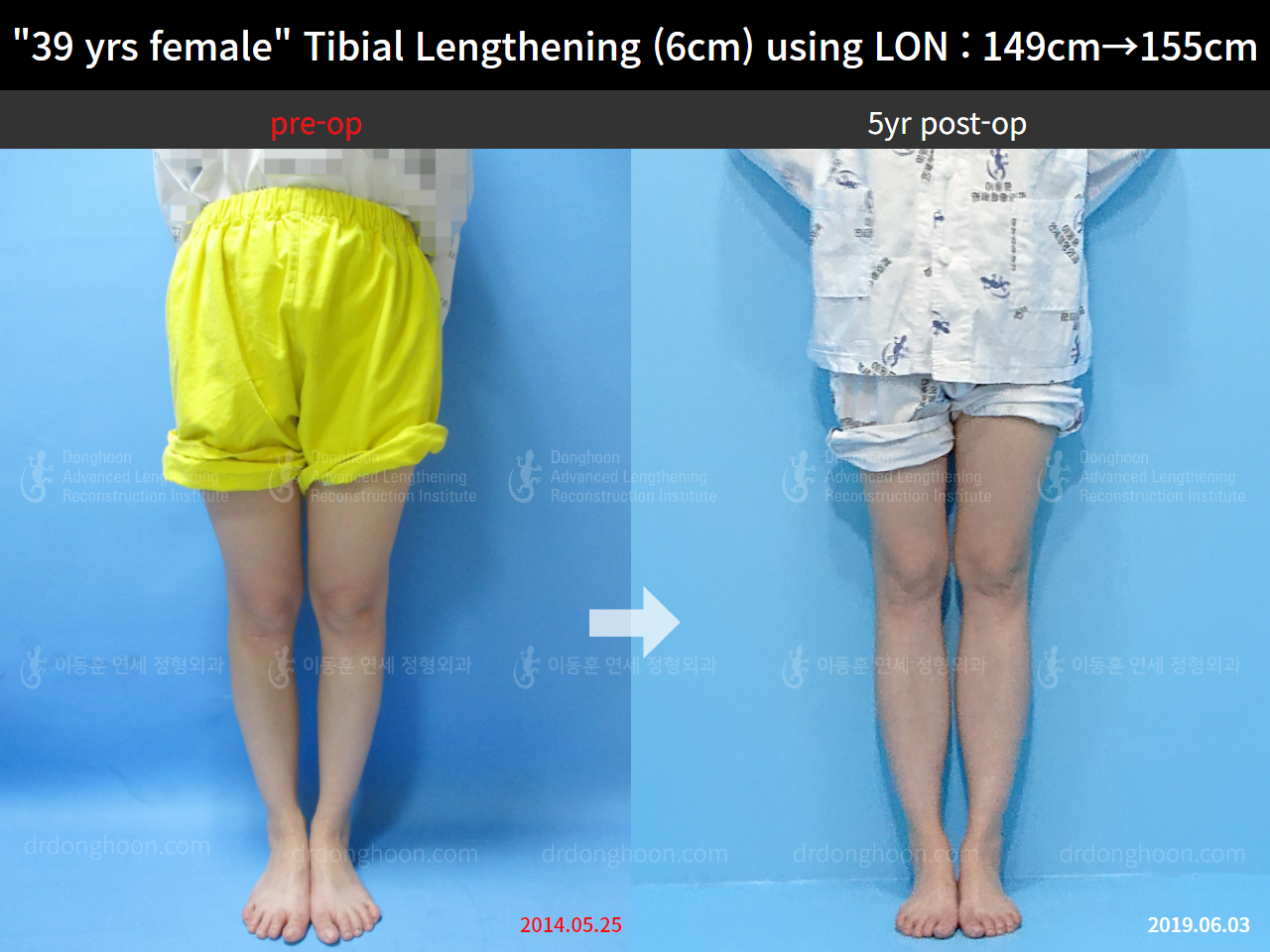Before and after cll lon, case 8626950, image 1, Dr. Donghoon institute (DALRI)