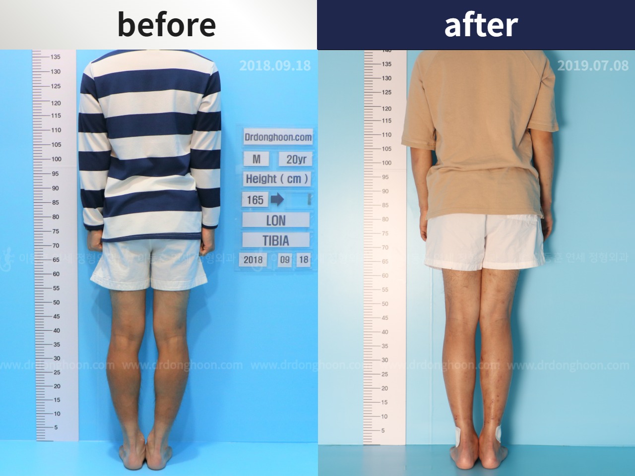 Before and after cll + deformity correction, case 4585674, image 2, Dr. Donghoon institute (DALRI)