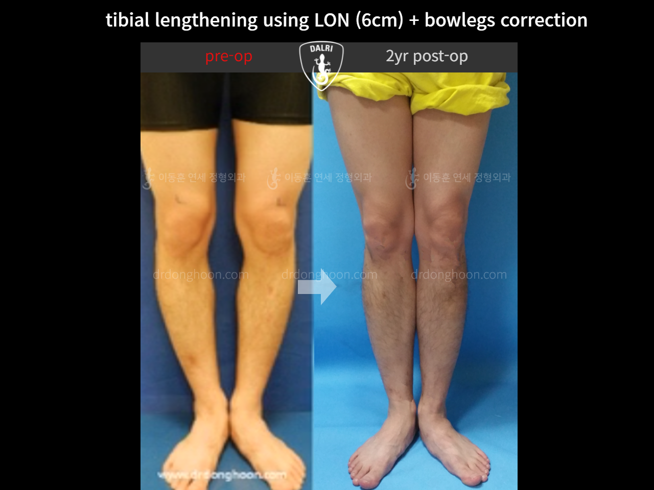 Before and after cll + deformity correction, case 4323167, image 2, Dr. Donghoon institute (DALRI)