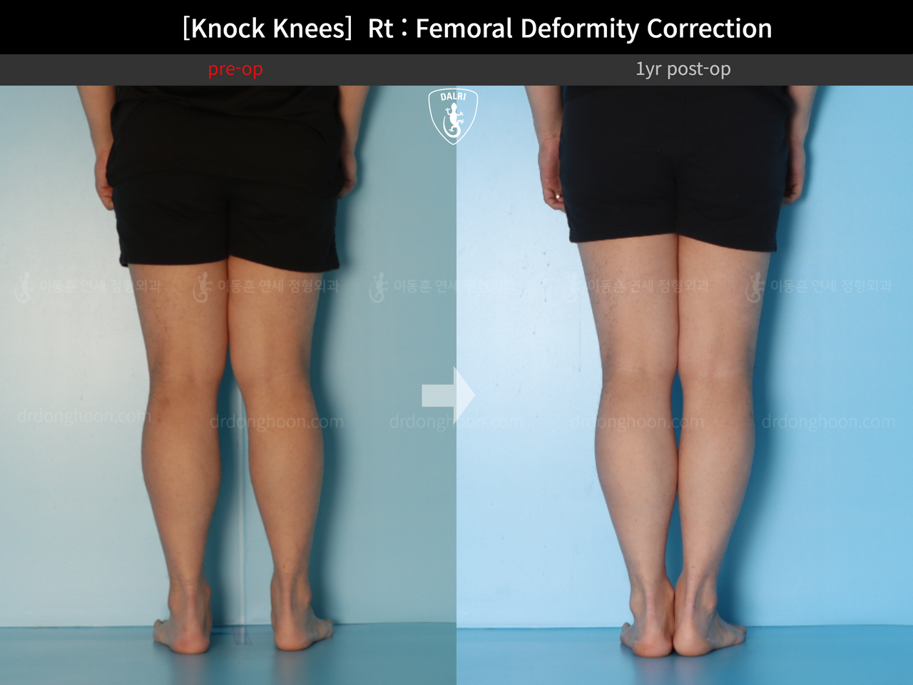 Before and after adult knock knees, case 14009233, image 4, Dr. Donghoon institute (DALRI)