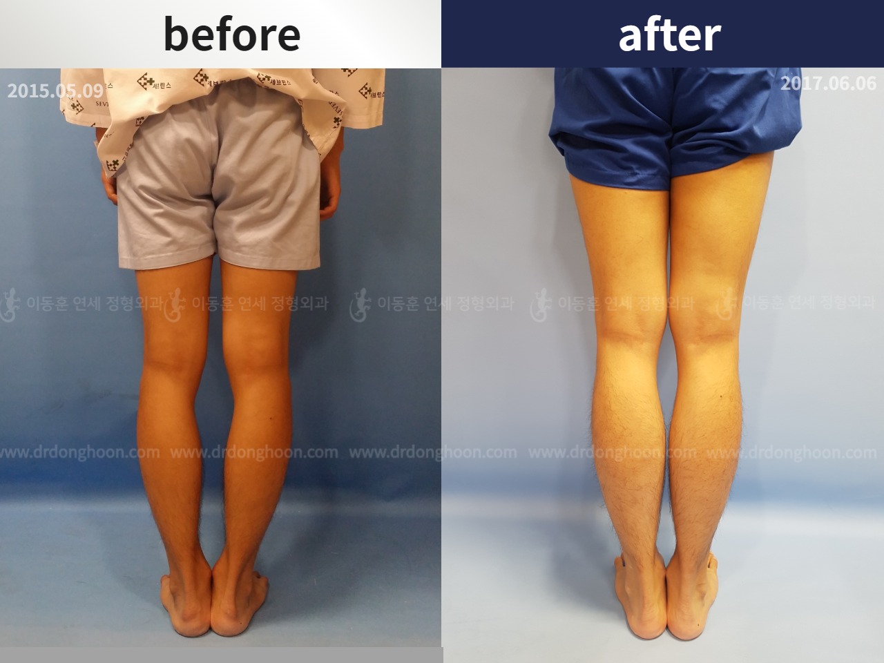 Before and after cll + deformity correction, case 4323161, image 3, Dr. Donghoon institute (DALRI)