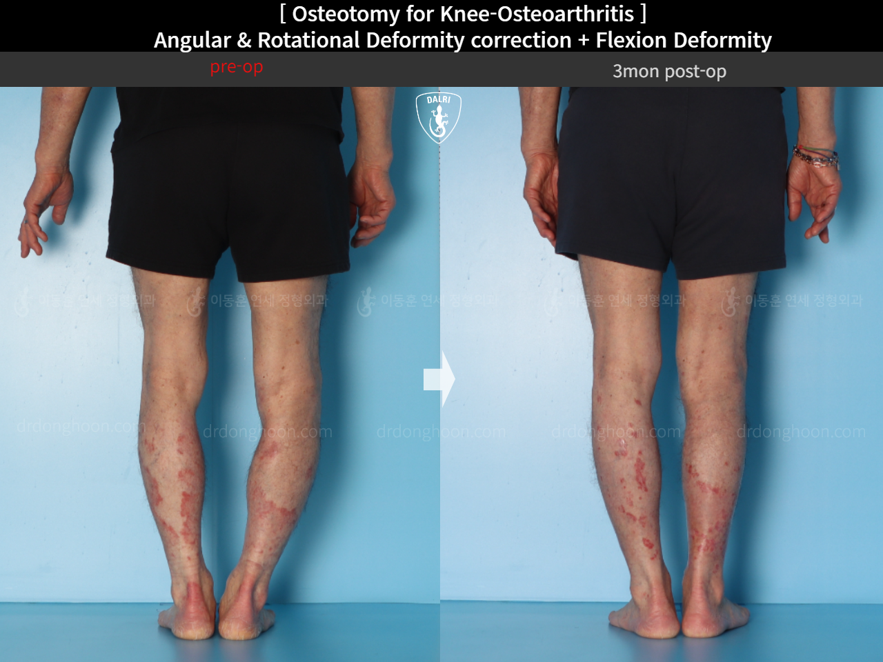 Before and after osteotomy for knee osteoarthritis, case 15362950, image 10, Dr. Donghoon institute (DALRI)
