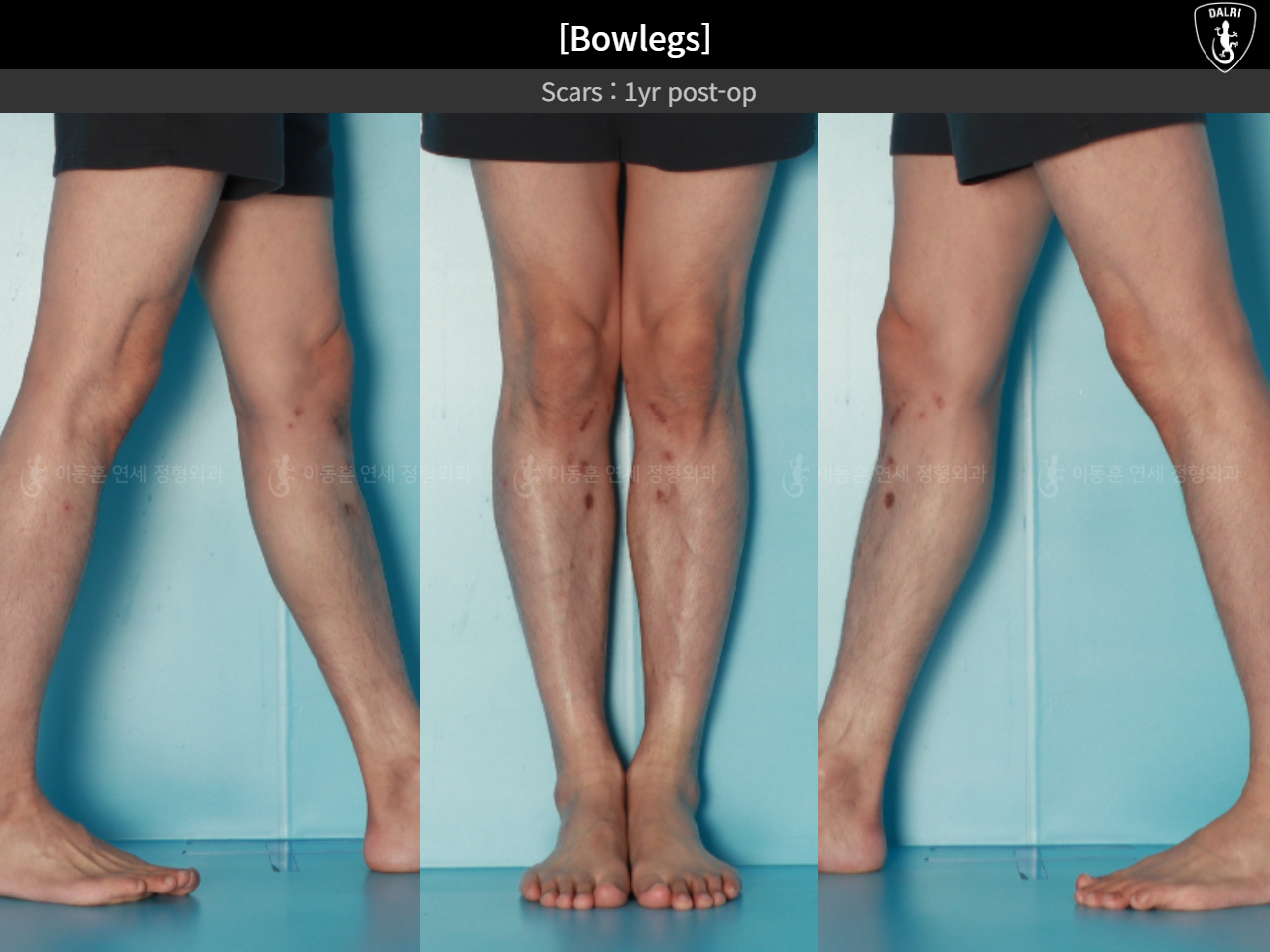Before and after adult bowlegs, case 32564251, image 14, Dr. Donghoon institute (DALRI)