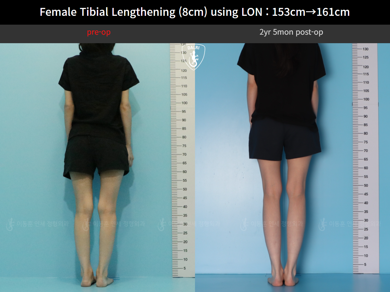 Before and after cll lon, case 128135191, image 3, Dr. Donghoon institute (DALRI)