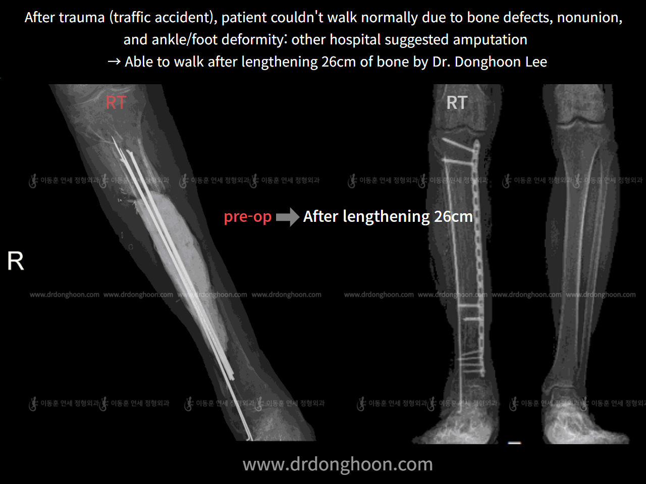 Before and after post-trauma deformity, case 7725984, image 3, Dr. Donghoon institute (DALRI)
