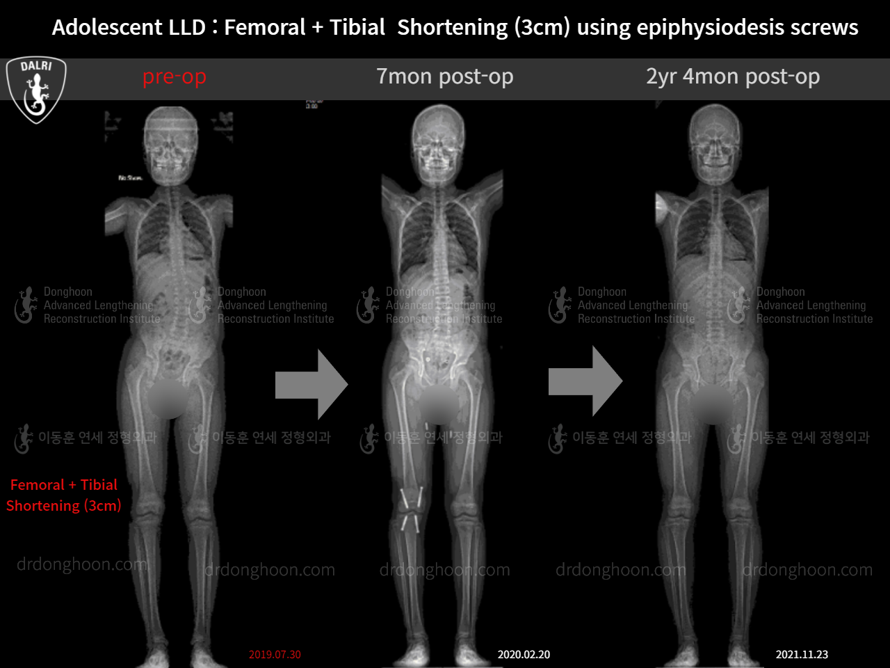 Before and after paediatric & adolescent lld, case 11511257, image 5, Dr. Donghoon institute (DALRI)