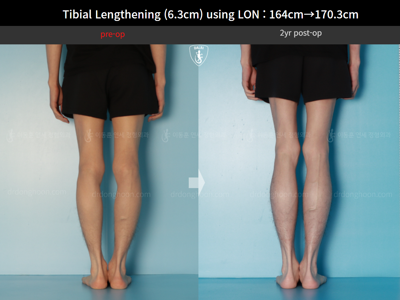 Before and after cll lon, case 16723608, image 10, Dr. Donghoon institute (DALRI)