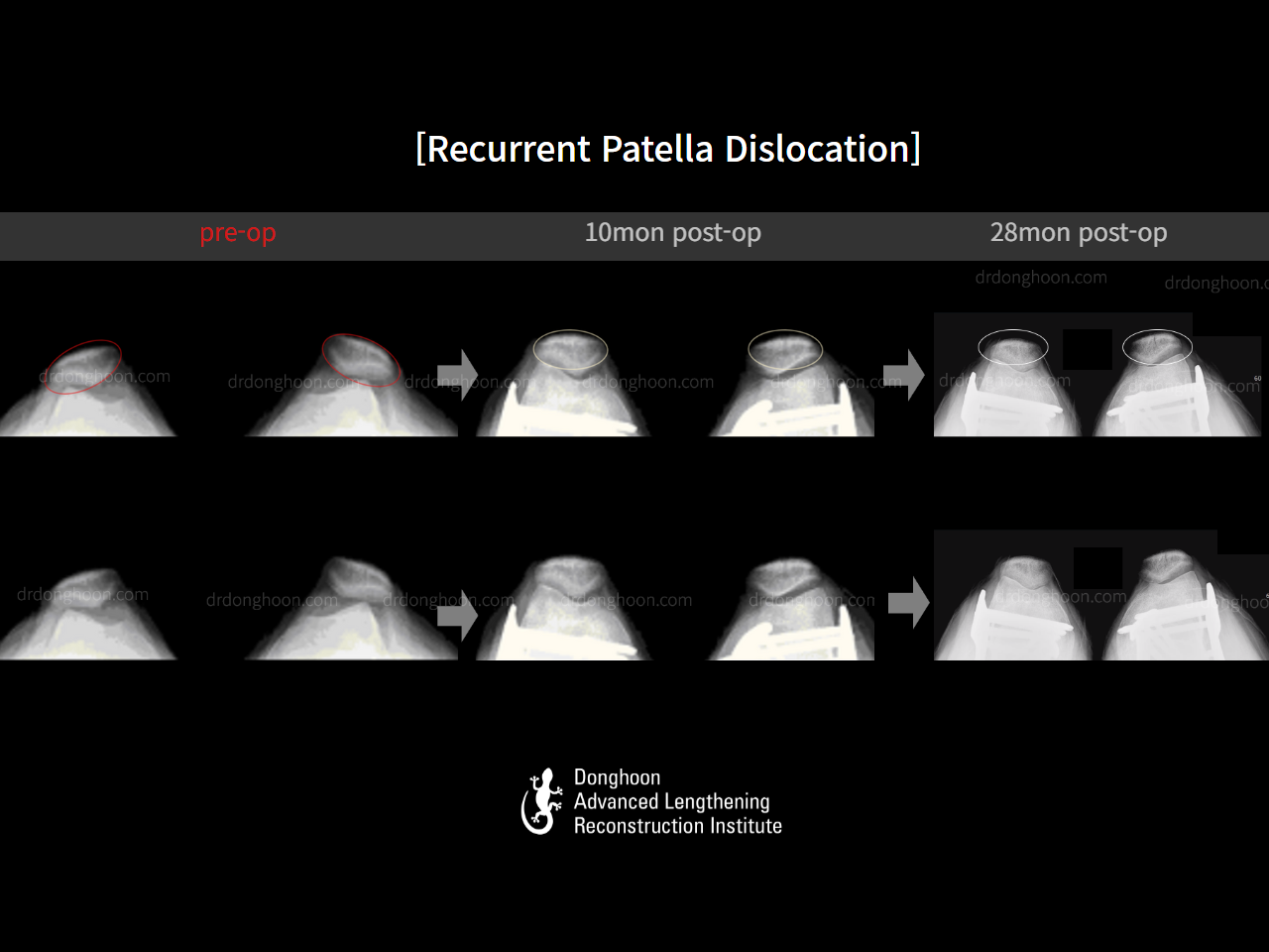Before and after recurrent patella dislocation, case 15131180, image 7, Dr. Donghoon institute (DALRI)