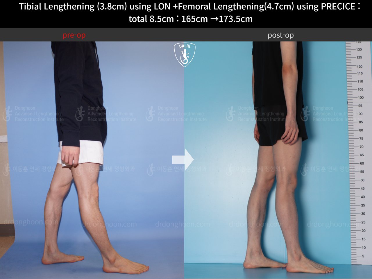Before and after cll precice, case 4576980, image 7, Dr. Donghoon institute (DALRI)