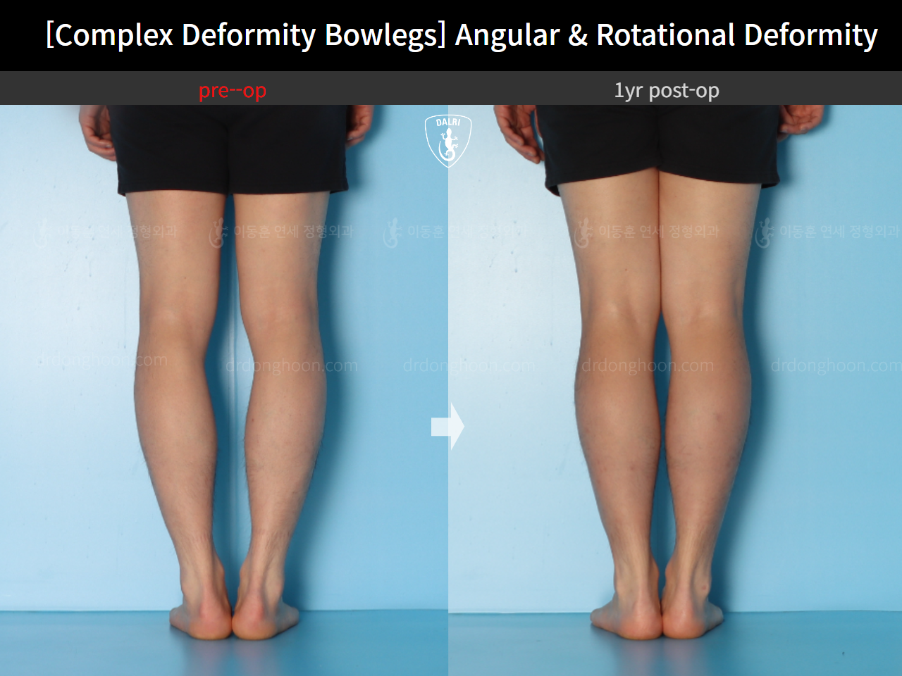 Before and after adult bowlegs, case 17229195, image 7, Dr. Donghoon institute (DALRI)