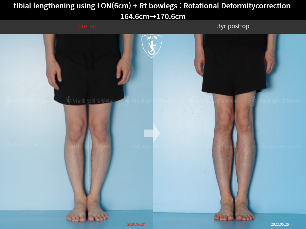 Before and after cll + deformity correction, case 15347322, image 5, Dr. Donghoon institute (DALRI)