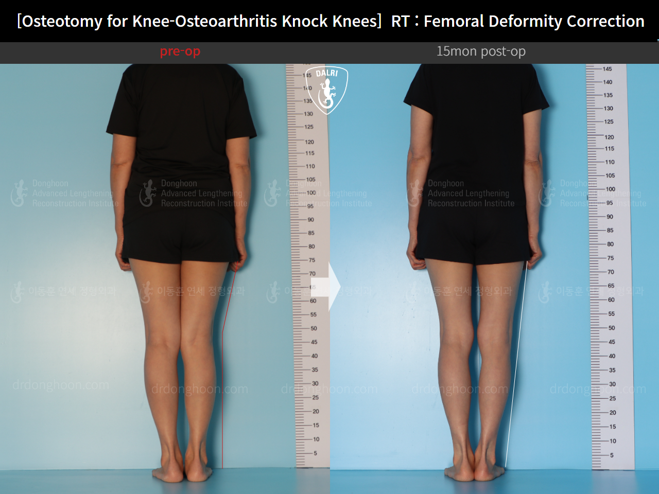 Before and after osteotomy for knee osteoarthritis, case 14462707, image 5, Dr. Donghoon institute (DALRI)