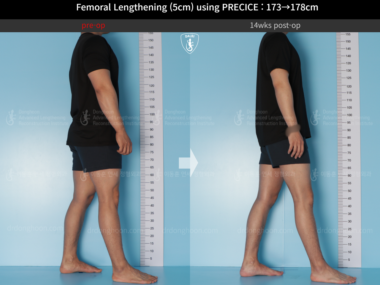 Before and after cll precice, case 14448457, image 3, Dr. Donghoon institute (DALRI)