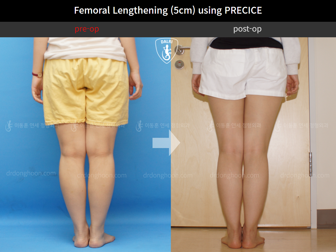 Before and after cll precice, case 4323409, image 4, Dr. Donghoon institute (DALRI)
