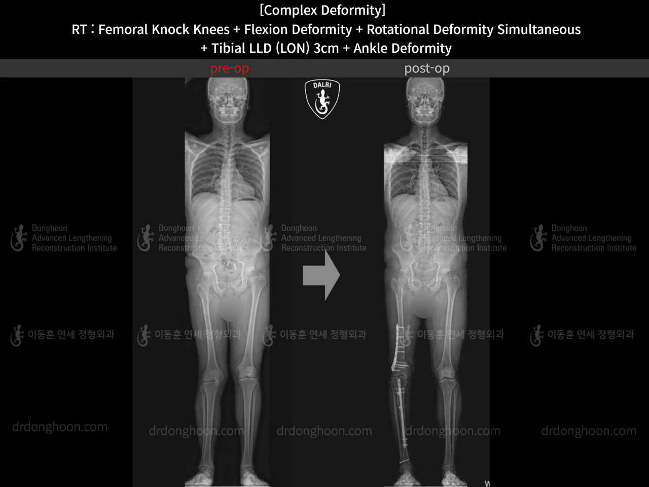 Before and after adult lld, case 14286604, image 7, Dr. Donghoon institute (DALRI)