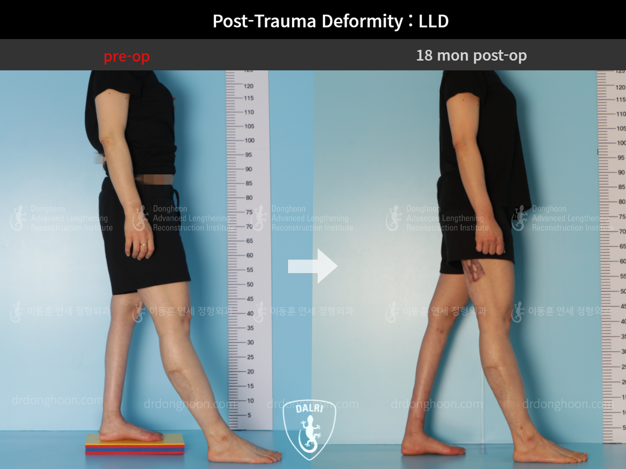Before and after post-trauma deformity, case 9125303, image 4, Dr. Donghoon institute (DALRI)