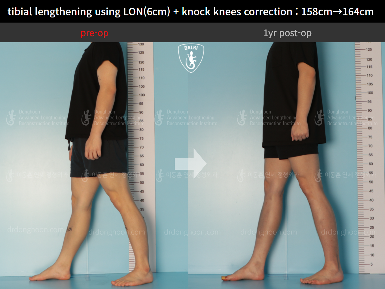 Before and after cll + deformity correction, case 9324521, image 4, Dr. Donghoon institute (DALRI)