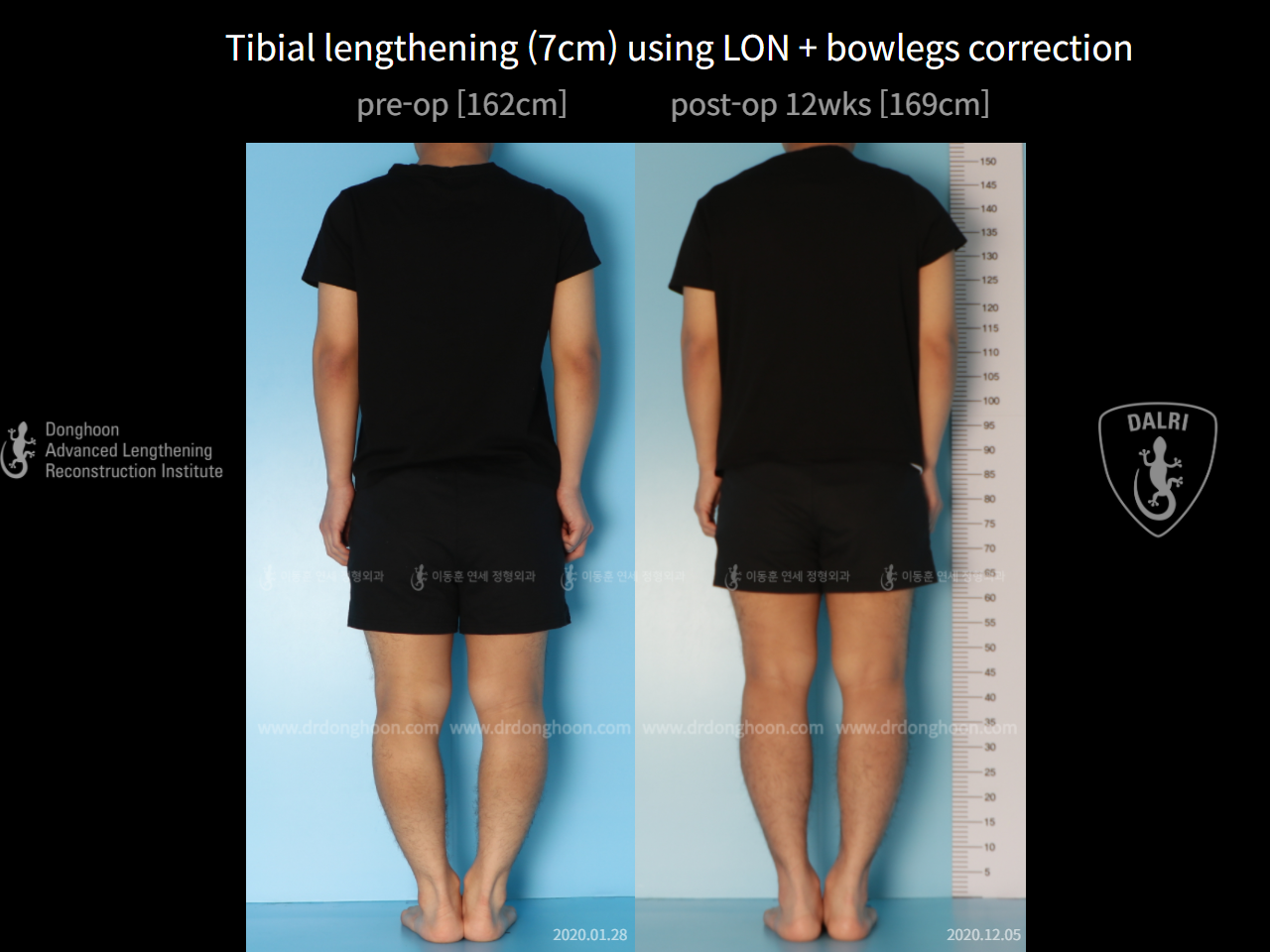 Before and after cll + deformity correction, case 6740433, image 3, Dr. Donghoon institute (DALRI)
