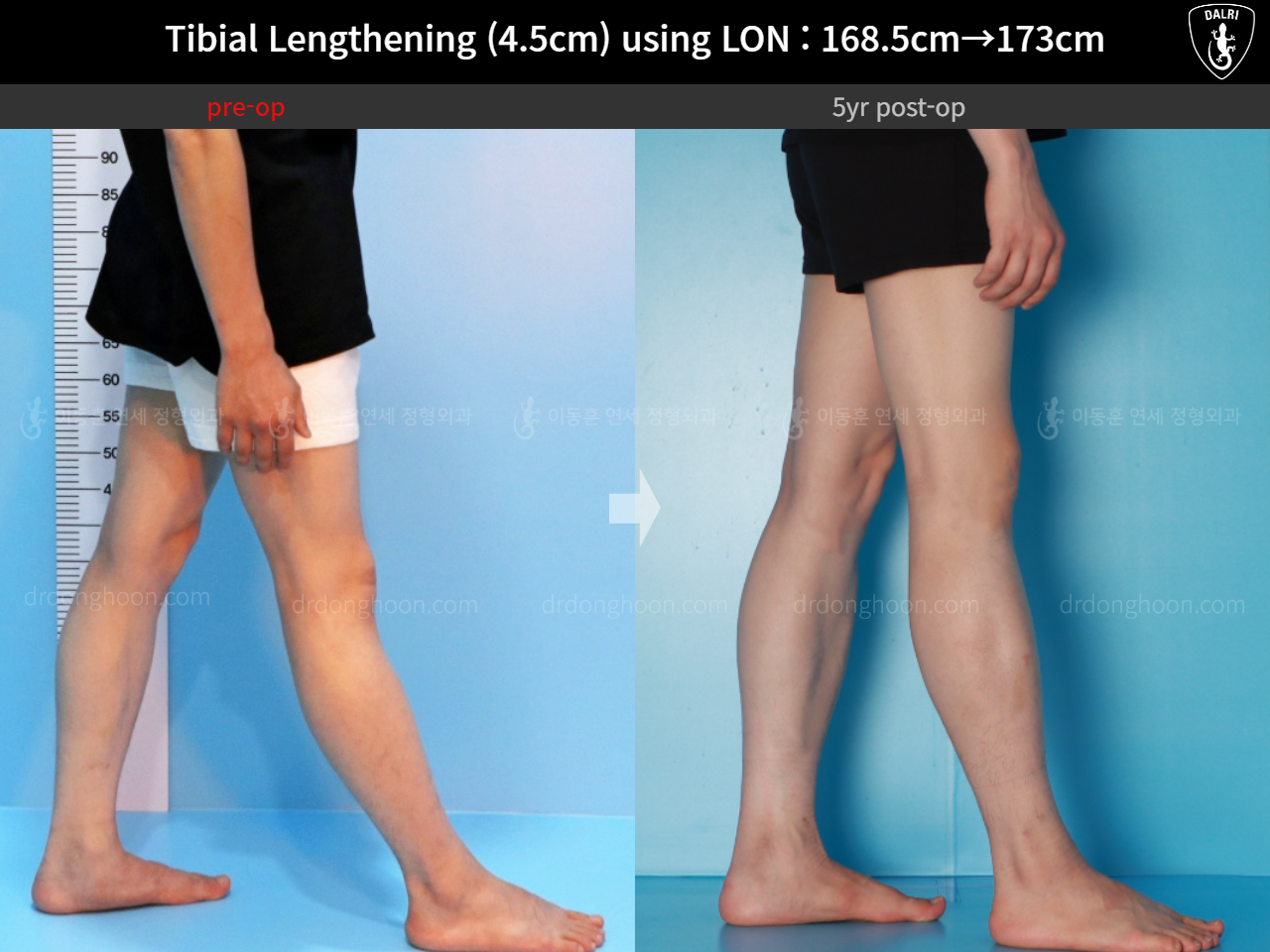 Before and after cll lon, case 16140967, image 9, Dr. Donghoon institute (DALRI)
