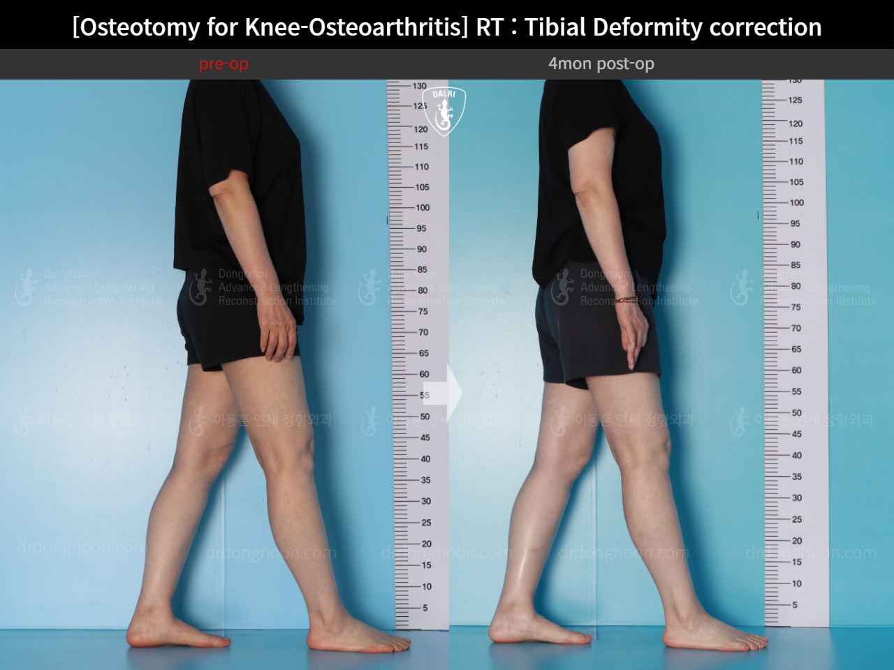 Before and after osteotomy for knee osteoarthritis, case 17890677, image 5, Dr. Donghoon institute (DALRI)