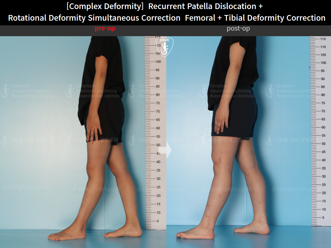 Before and after recurrent patella dislocation, case 16298897, image 4, Dr. Donghoon institute (DALRI)