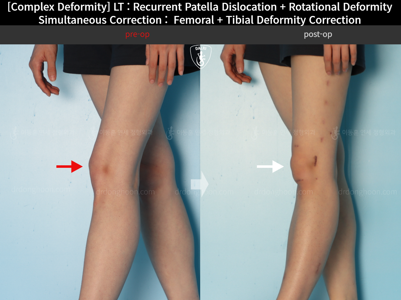 Before and after adult bowlegs, case 18088212, image 1, Dr. Donghoon institute (DALRI)
