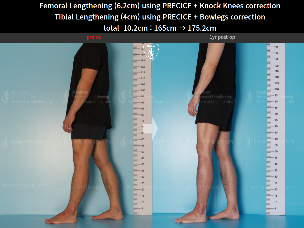Before and after cll + deformity correction, case 15903252, image 6, Dr. Donghoon institute (DALRI)